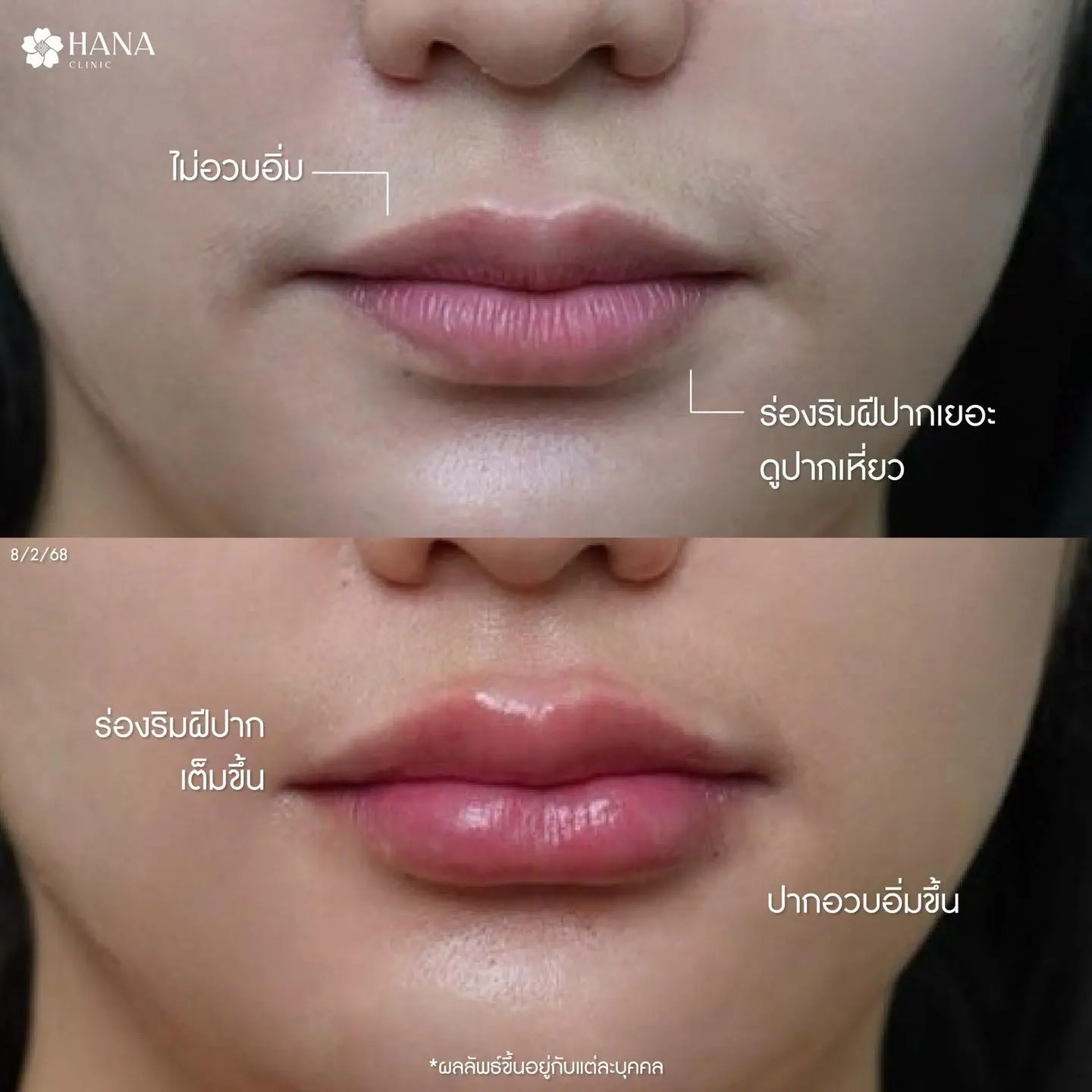 โปรแกรมฟิลเลอร์ปาก ระยอง3