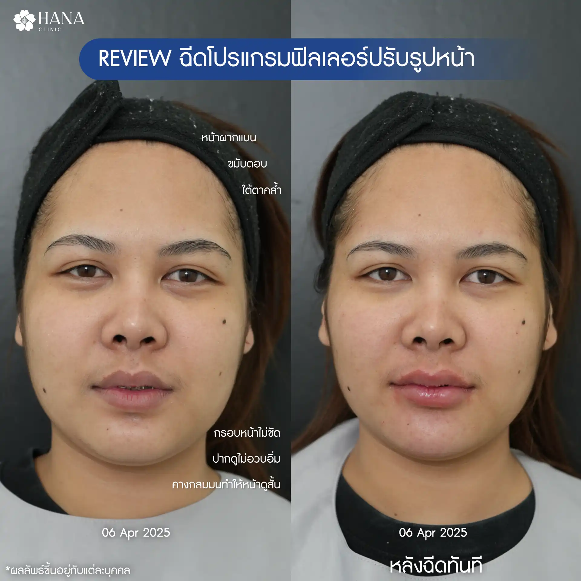 BF-AF K.ภัทรชา-01