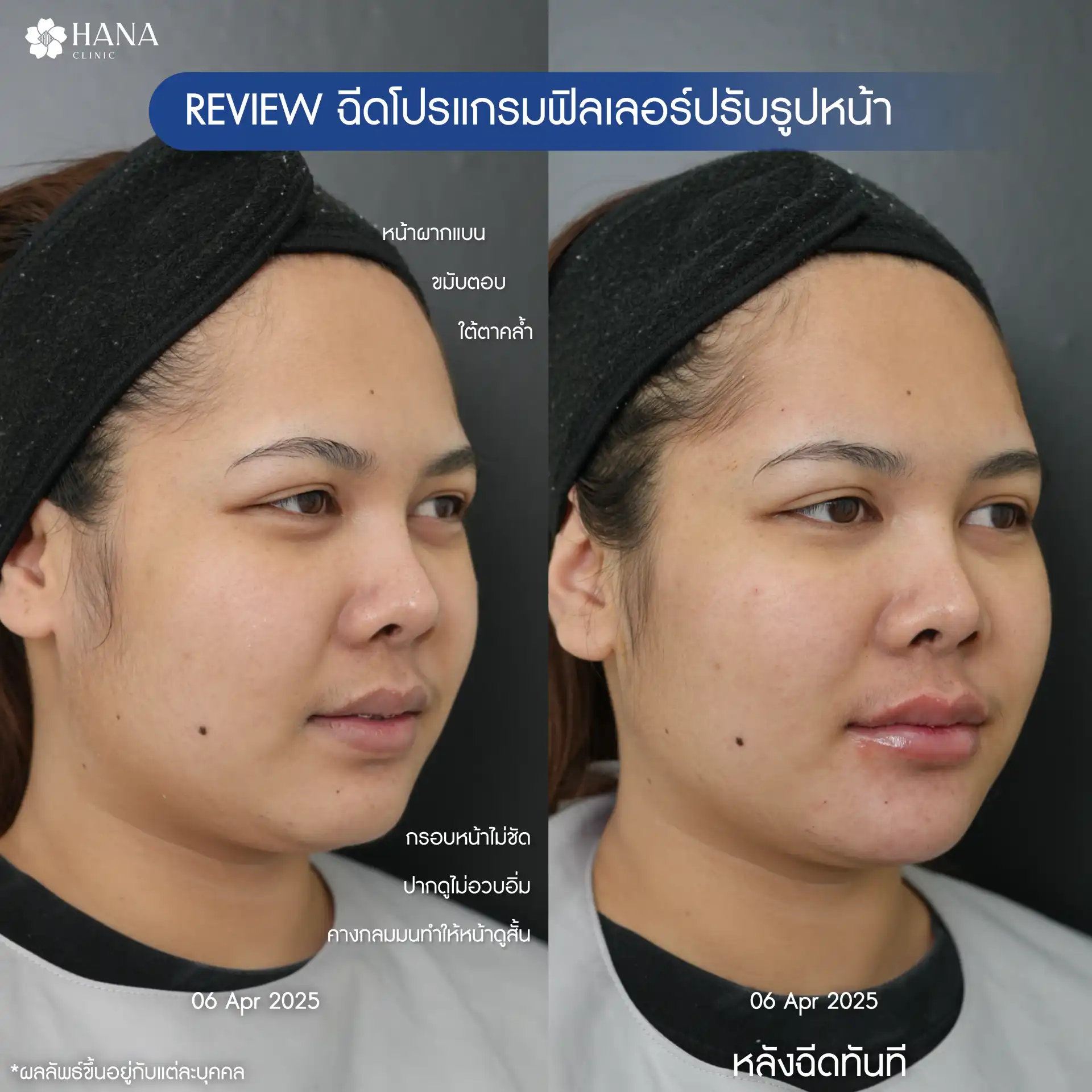 BF-AF K.ภัทรชา-02