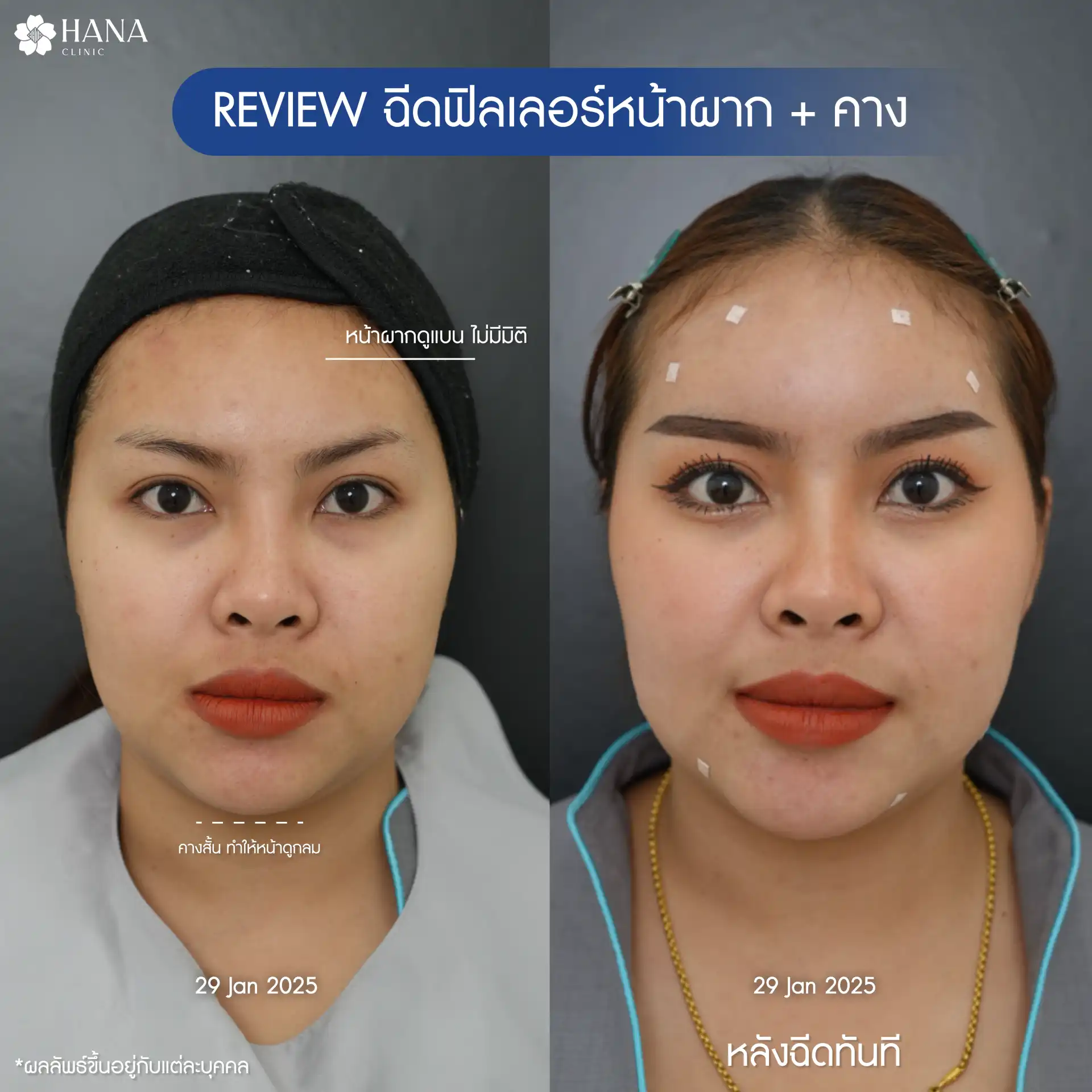 รีวิวโปรแกรมฉีดฟิลเลอร์หน้าผาก hana clinic 1