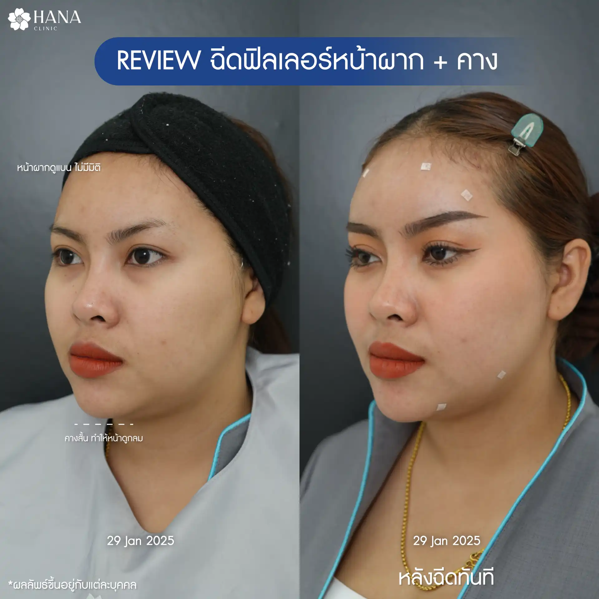 รีวิวโปรแกรมฉีดฟิลเลอร์หน้าผาก hana clinic 2