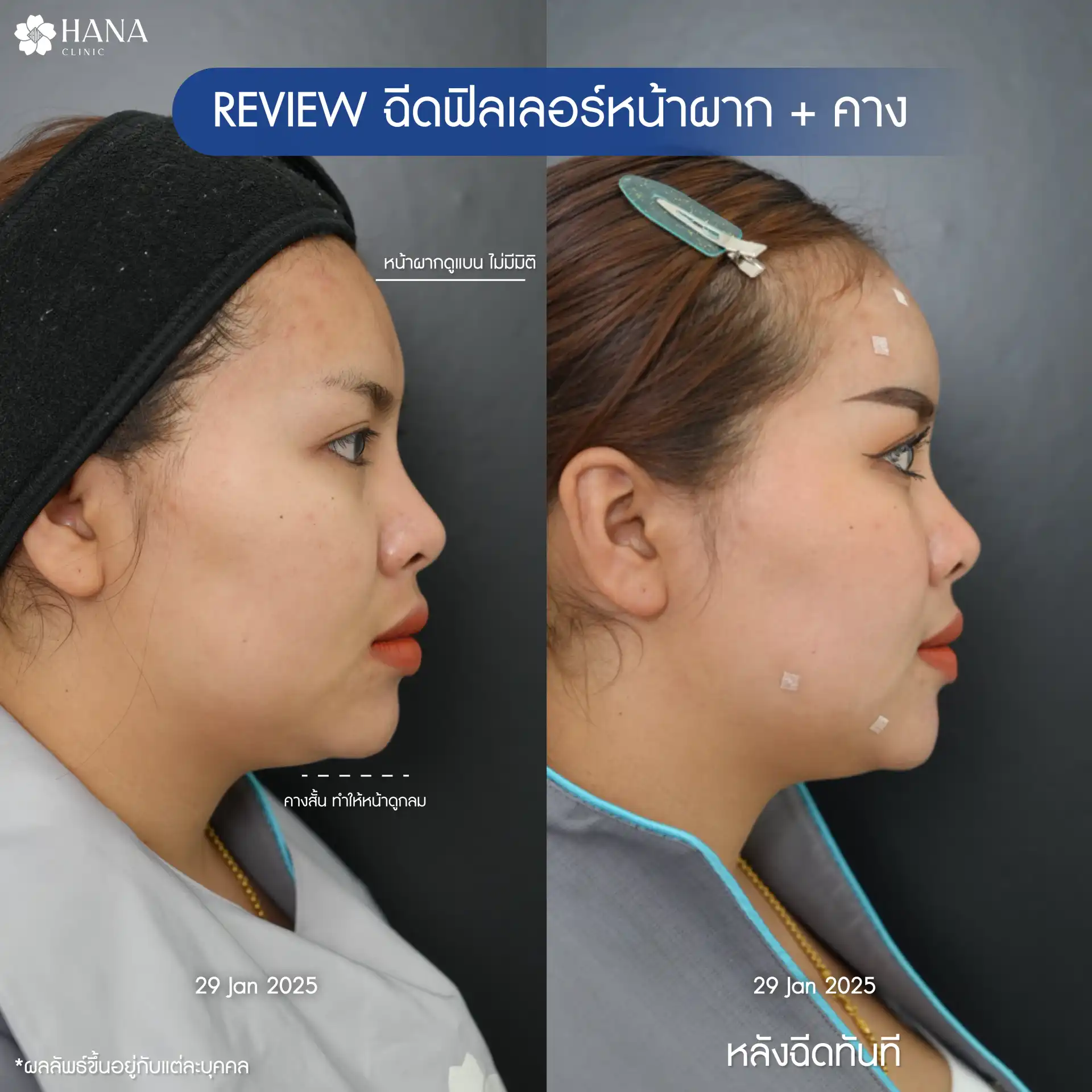 รีวิวโปรแกรมฉีดฟิลเลอร์หน้าผาก hana clinic 4