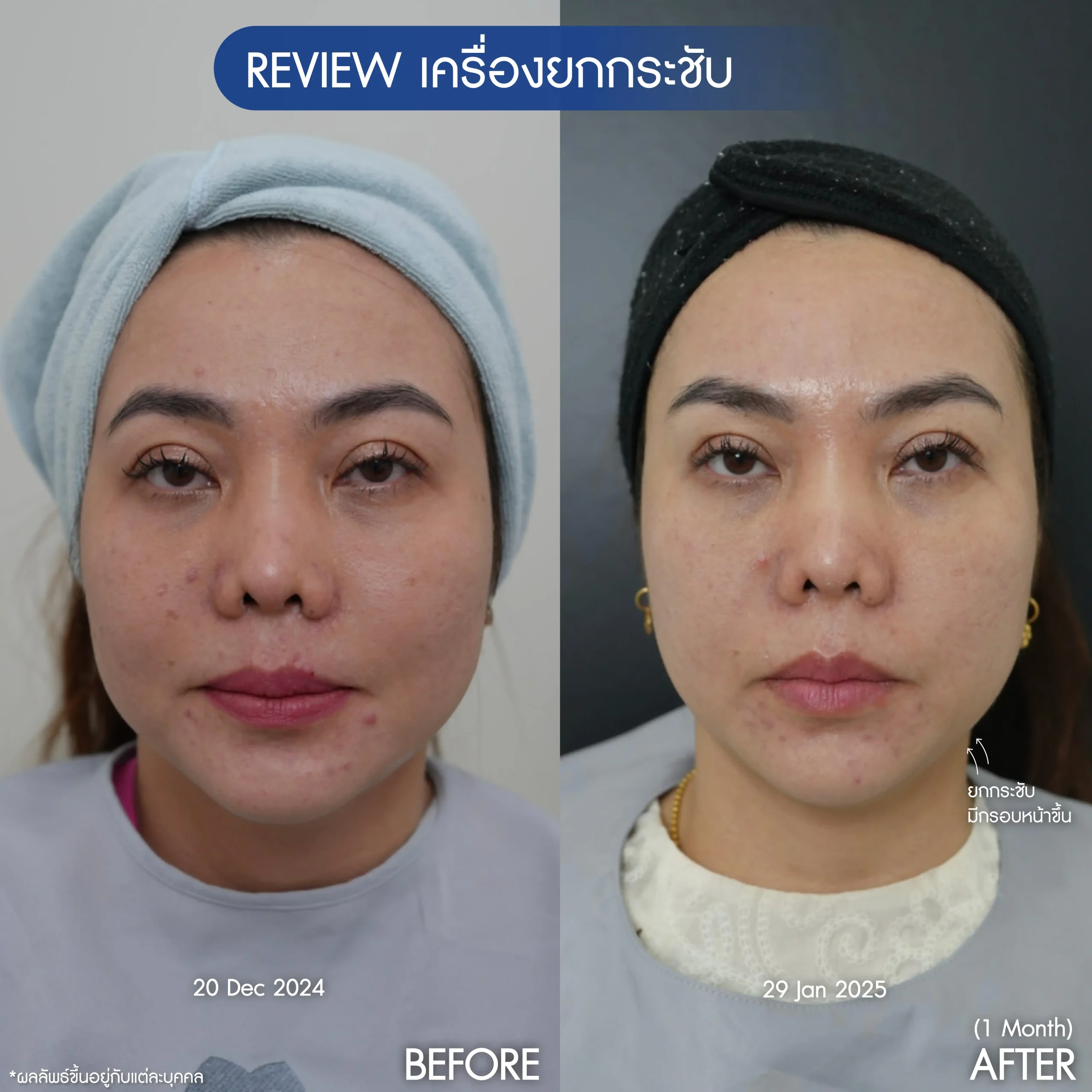 รีวิวเครื่องยกกระชับ K.นิด-01