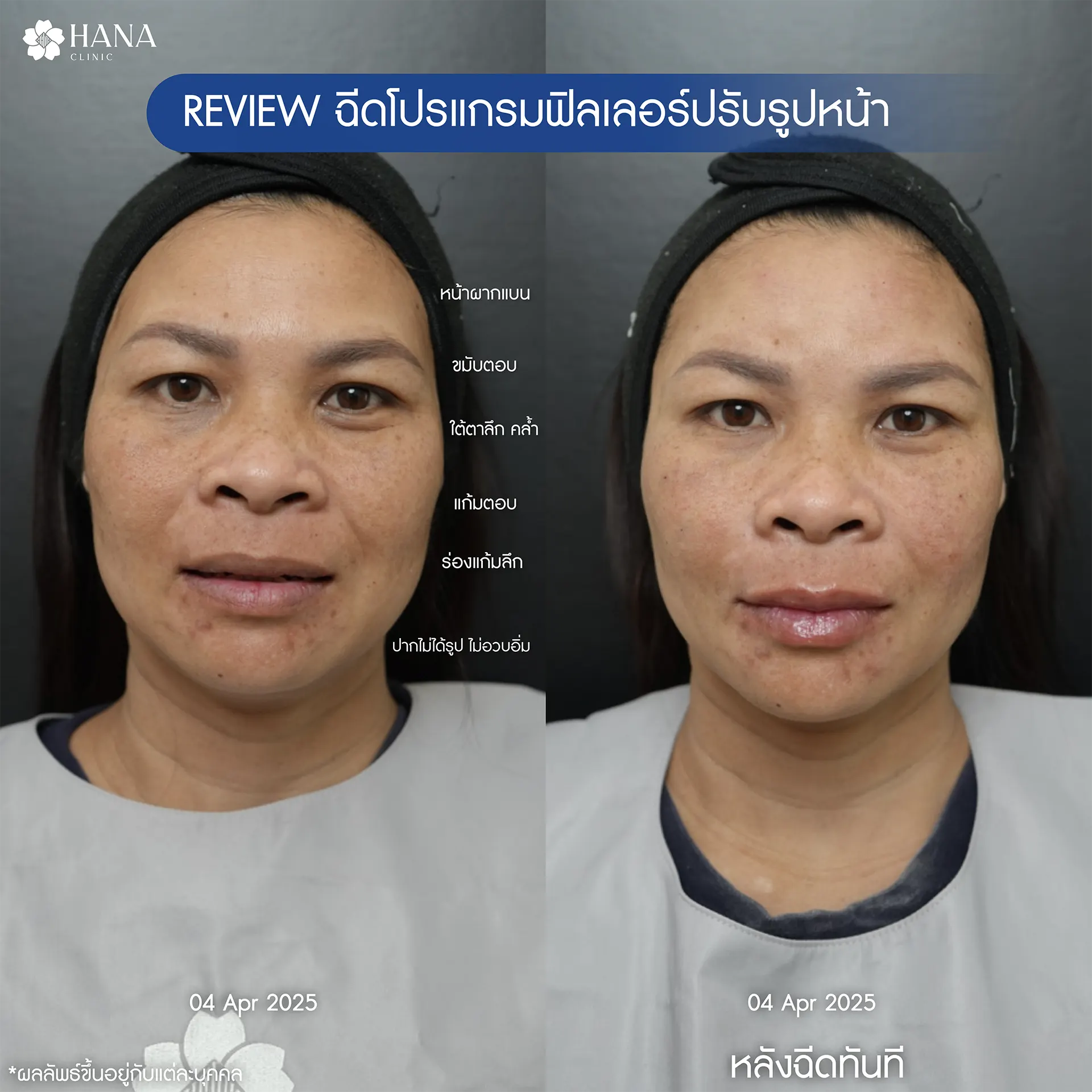 ฟิลเลอร์ร่องแก้ม