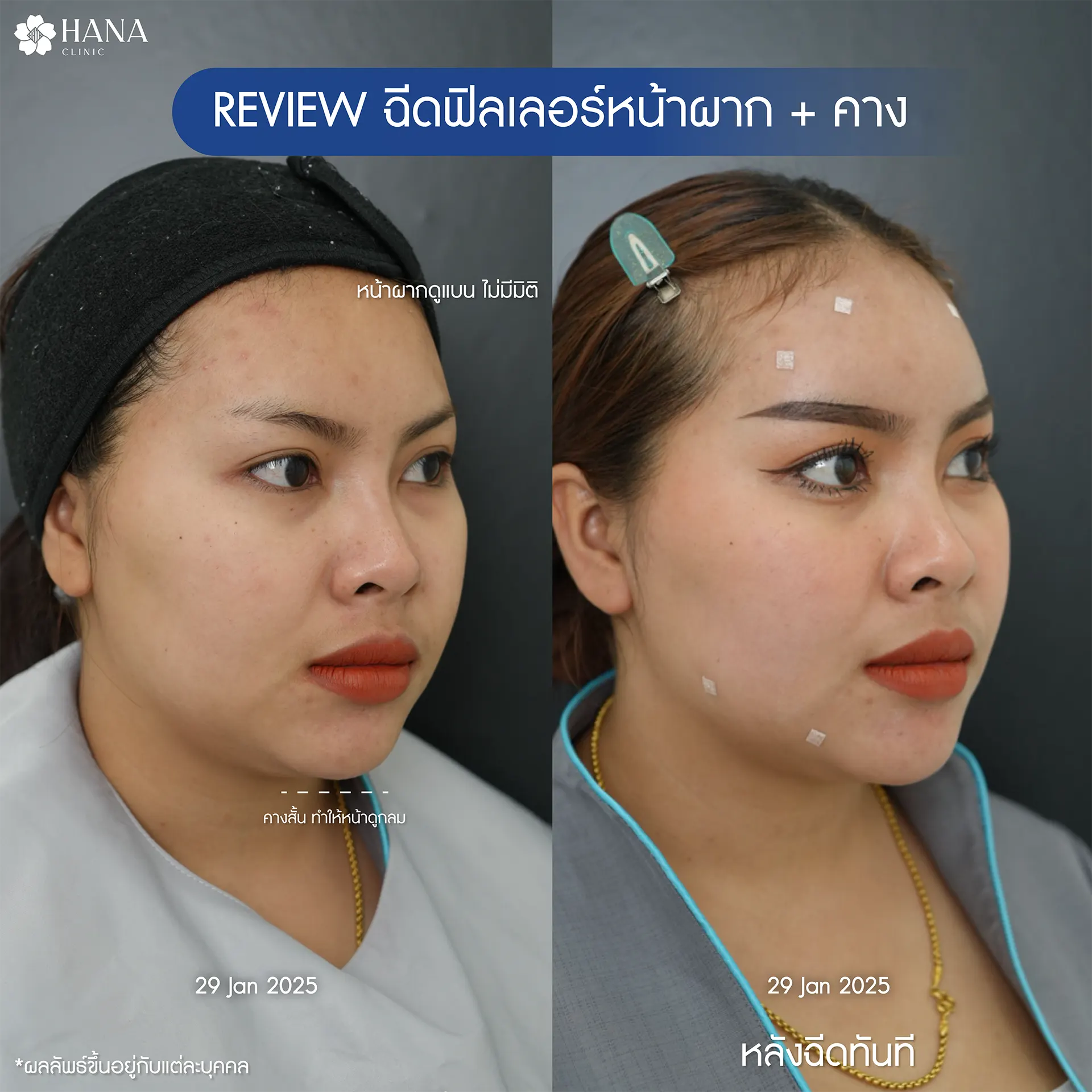 ฟิลเลอร์หน้าผาก