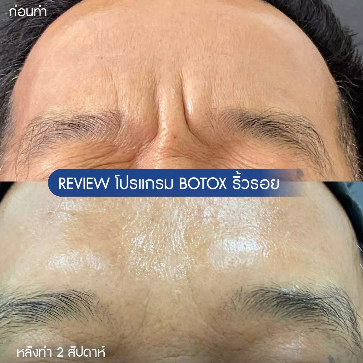 AnyConv.com__รีวิวโบริ้วรอย-07