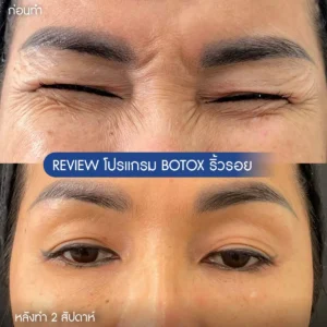 ลดริ้วรอยบริเวณหางตา