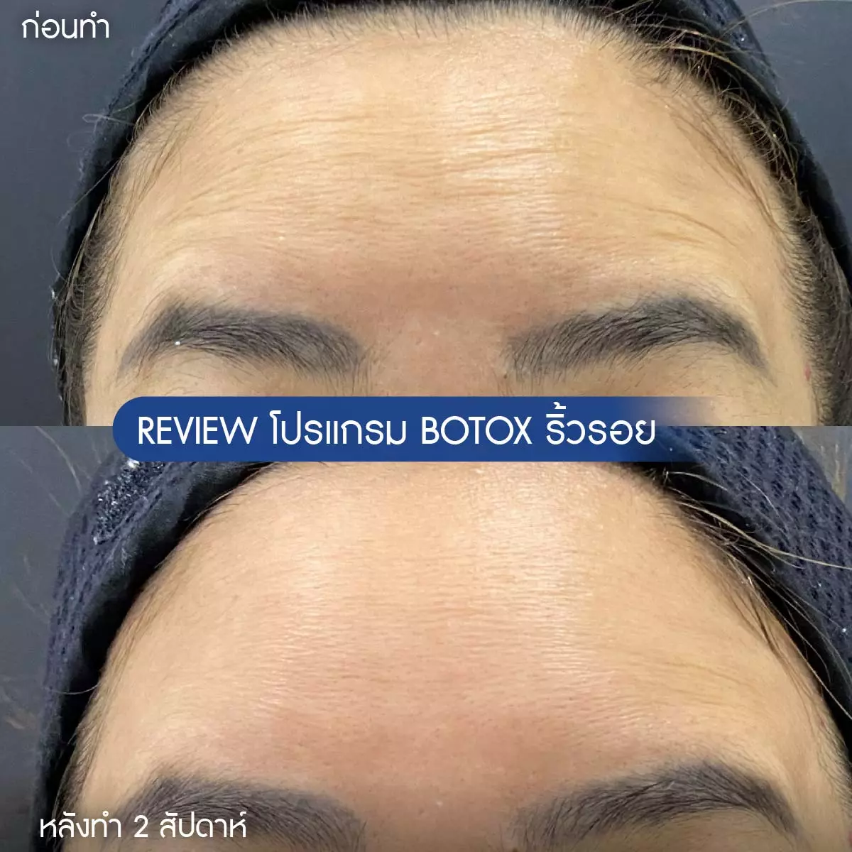 AnyConv.com__รีวิวโบริ้วรอย-09