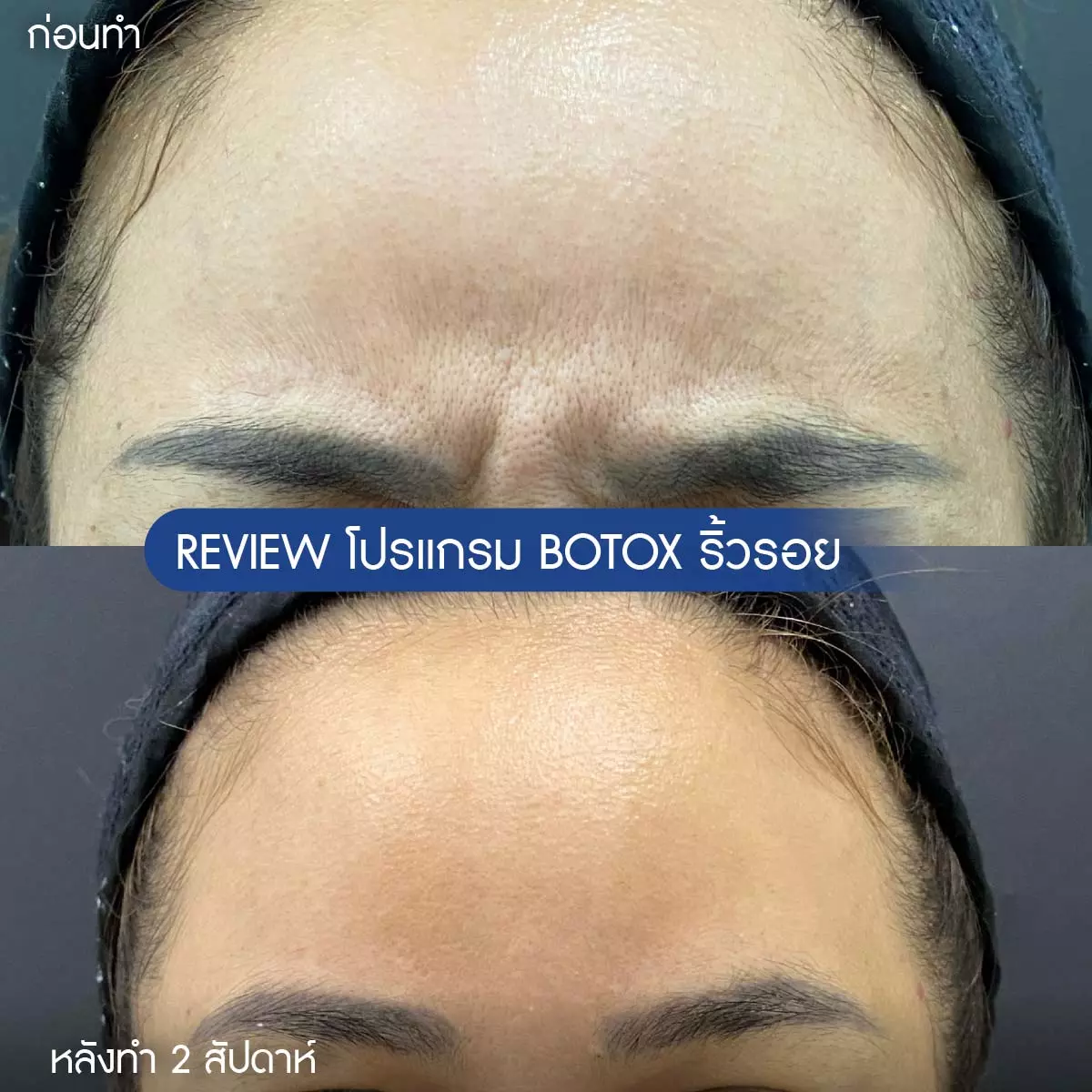 AnyConv.com__รีวิวโบริ้วรอย-11