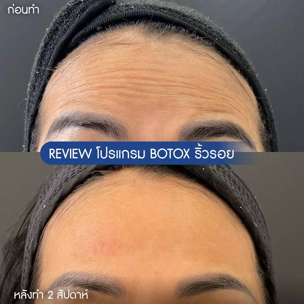 รีวิวโบท็อกซ์ริ้วรอย