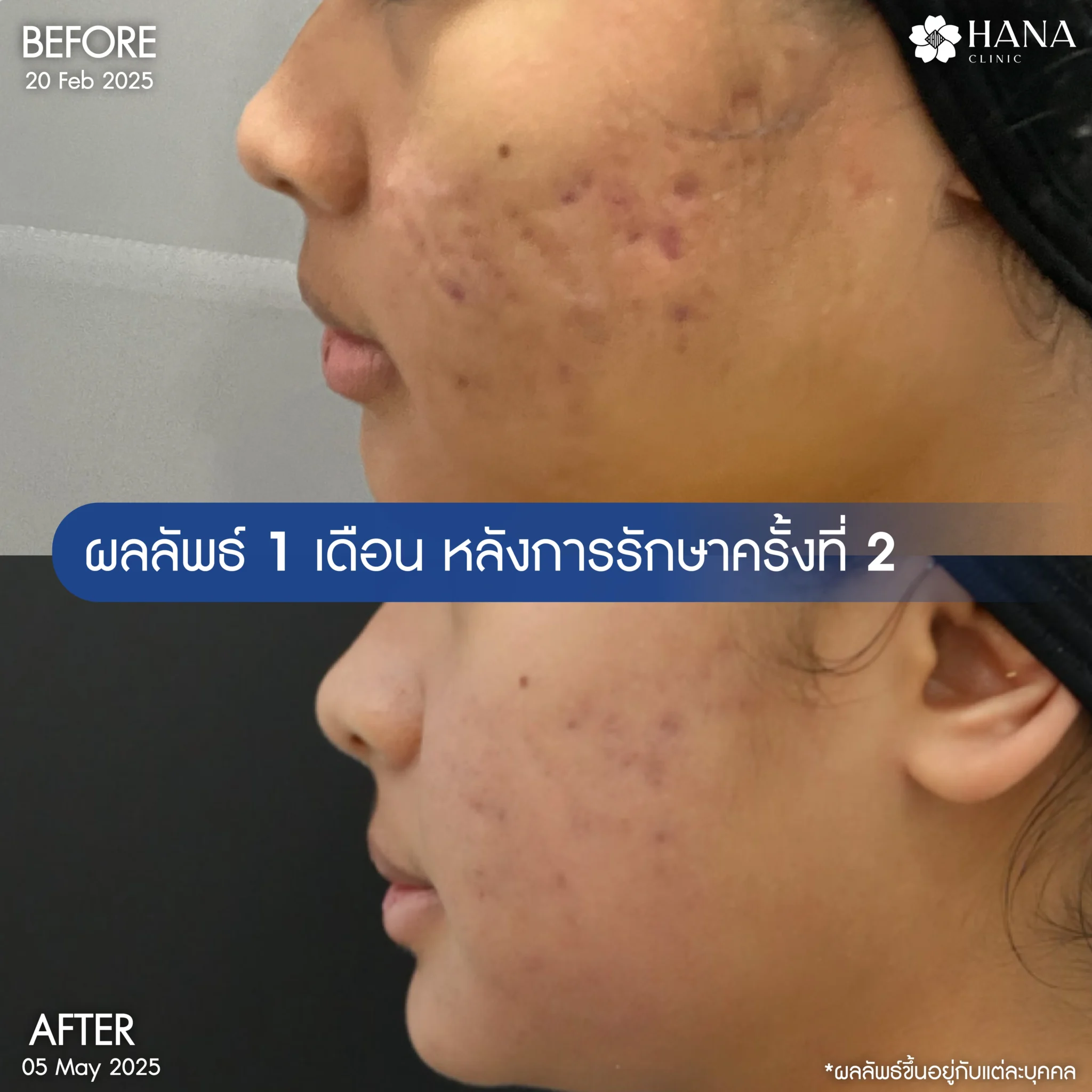 รีวิวรักษาหน้าหลุมสิว