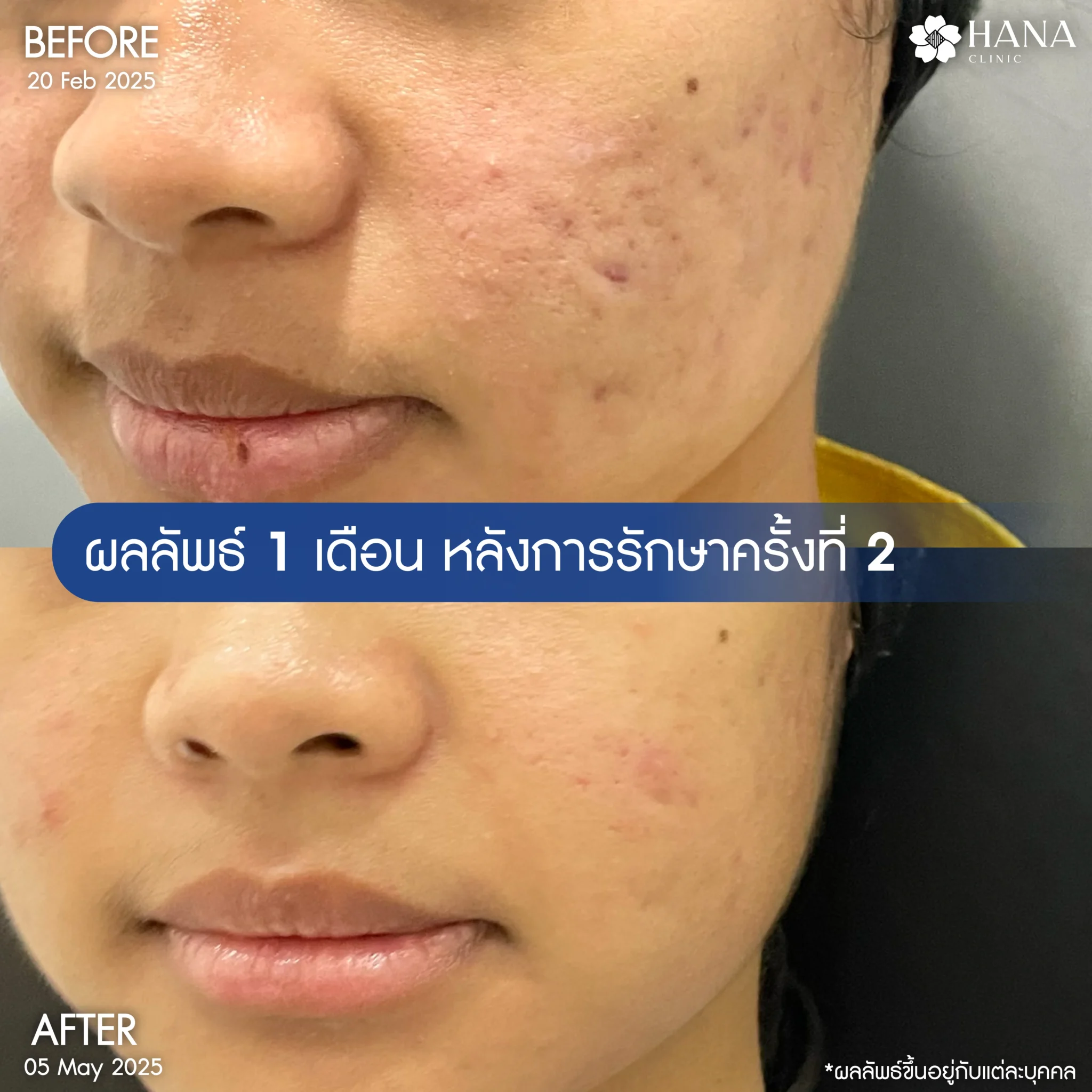 รีวิวรักษาหน้าหลุมสิว