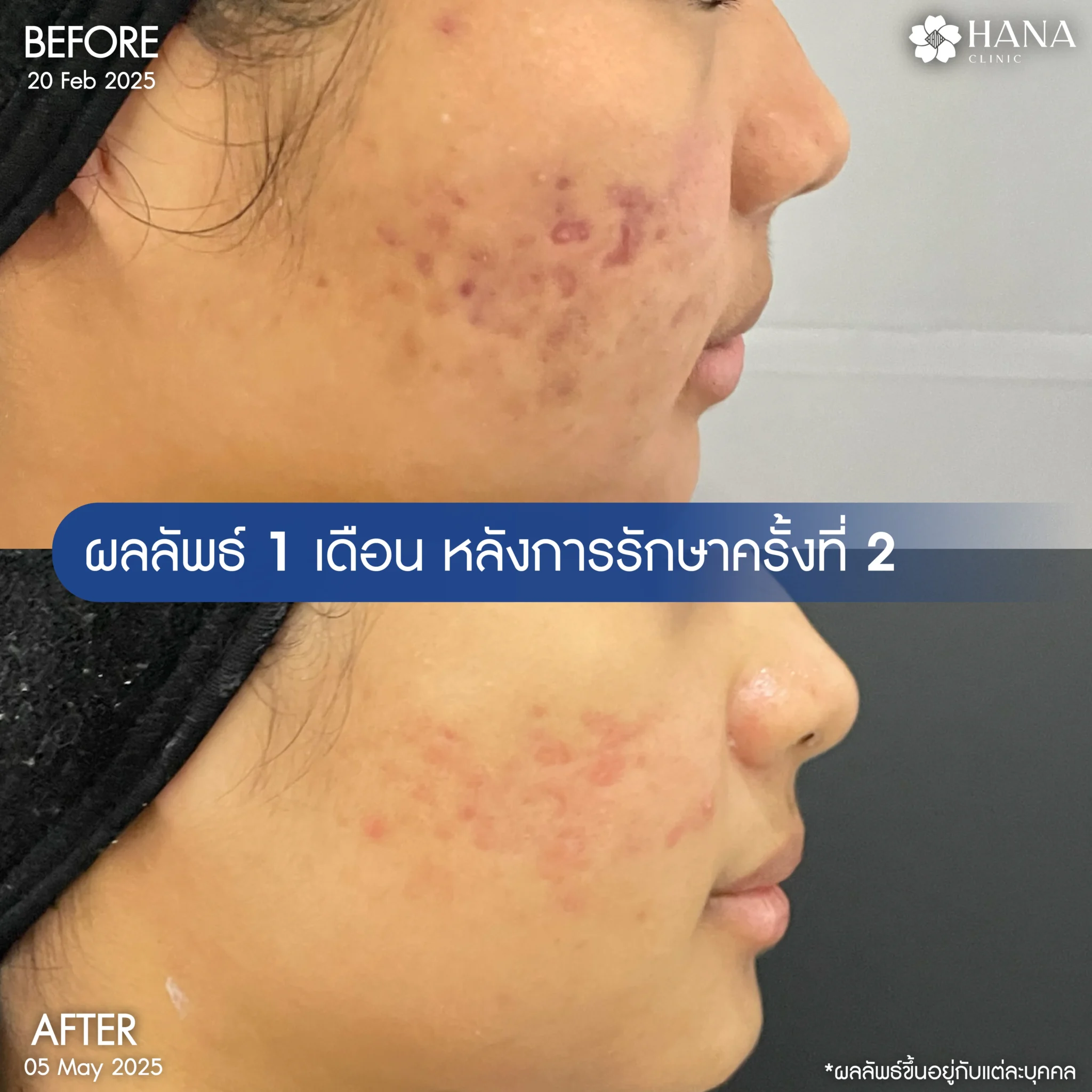 รีวิวรักษาหน้าหลุมสิว
