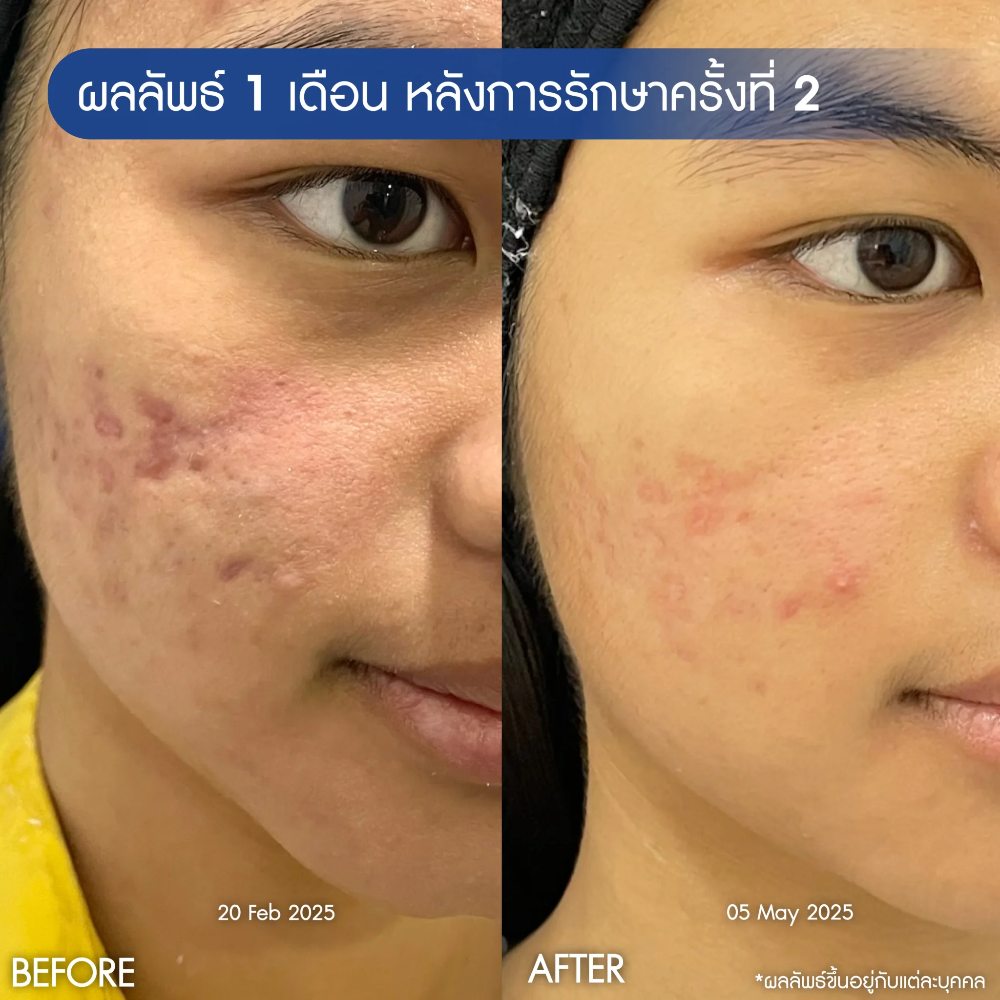 รีวิวรักษาหน้าหลุมสิว