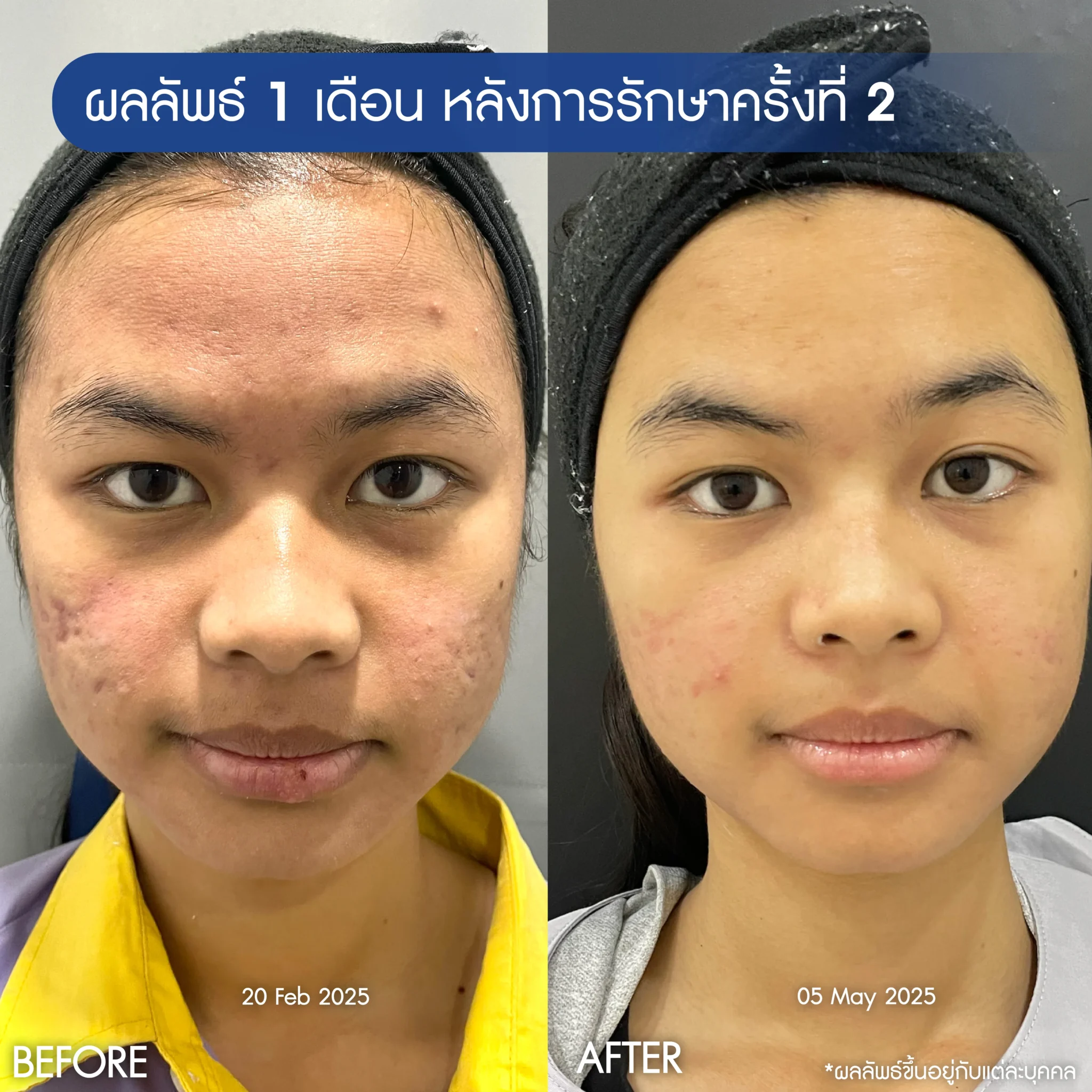 รีวิวรักษาหน้าหลุมสิว