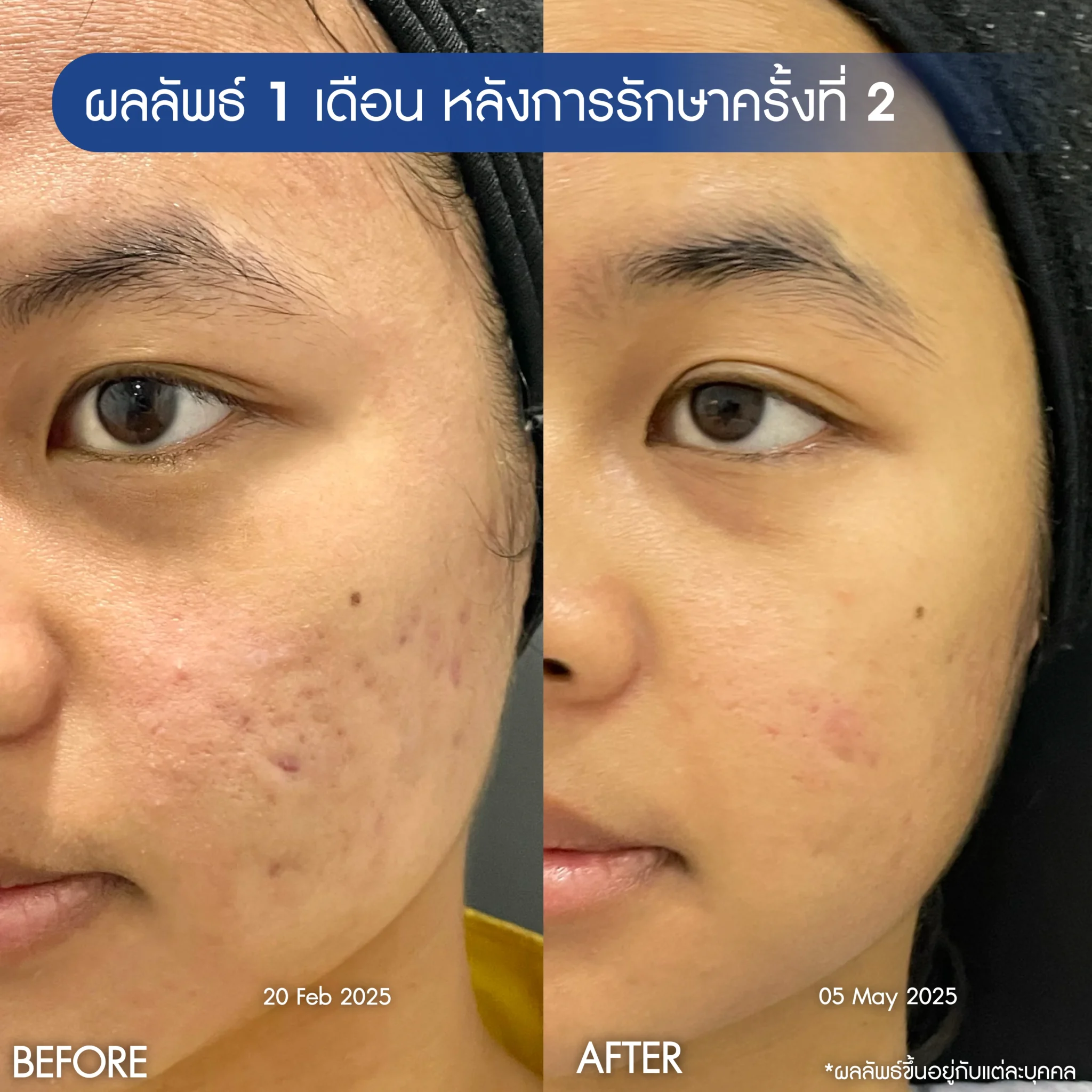 รีวิวรักษาหน้าหลุมสิว