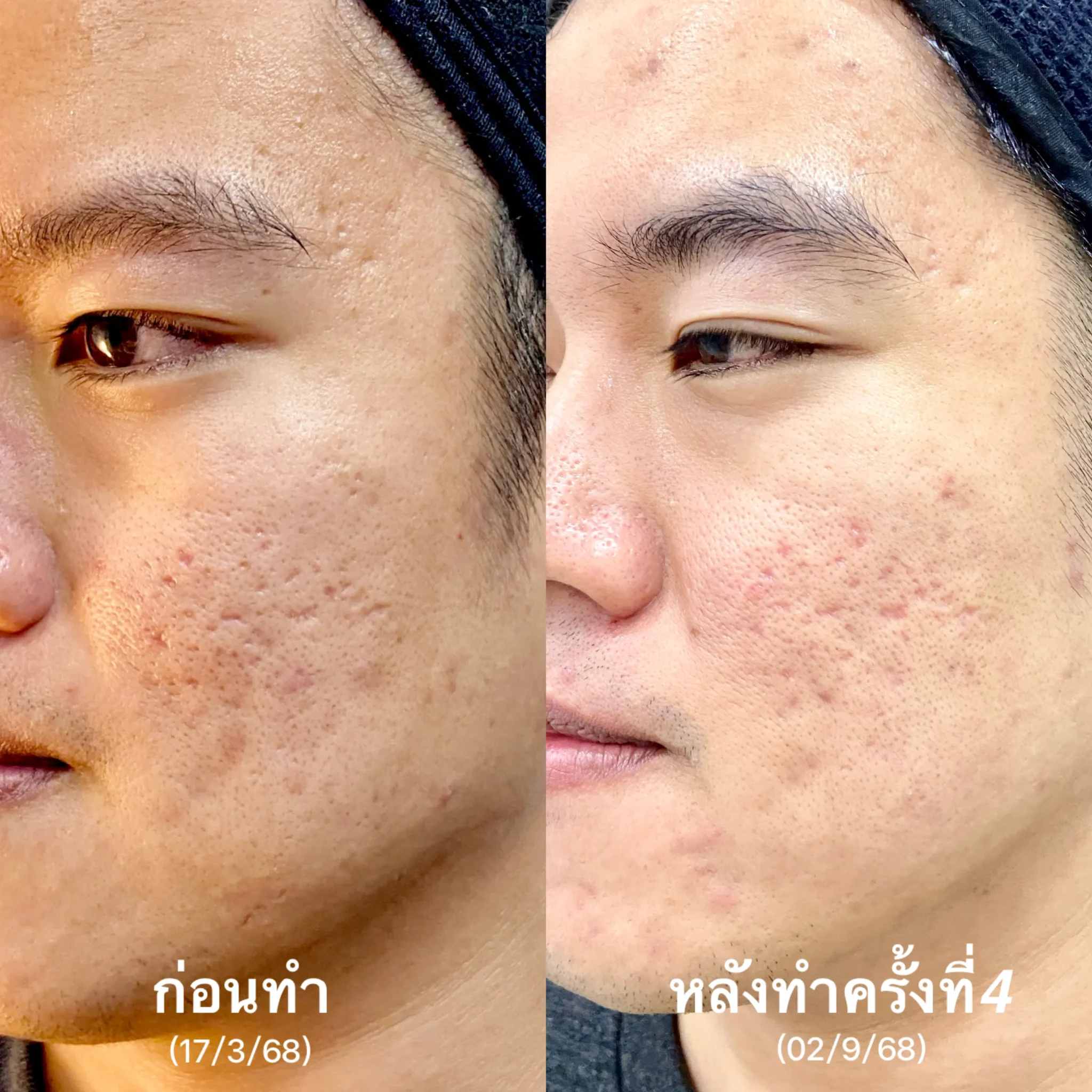 รีวิวรักษาหน้าหลุมสิว