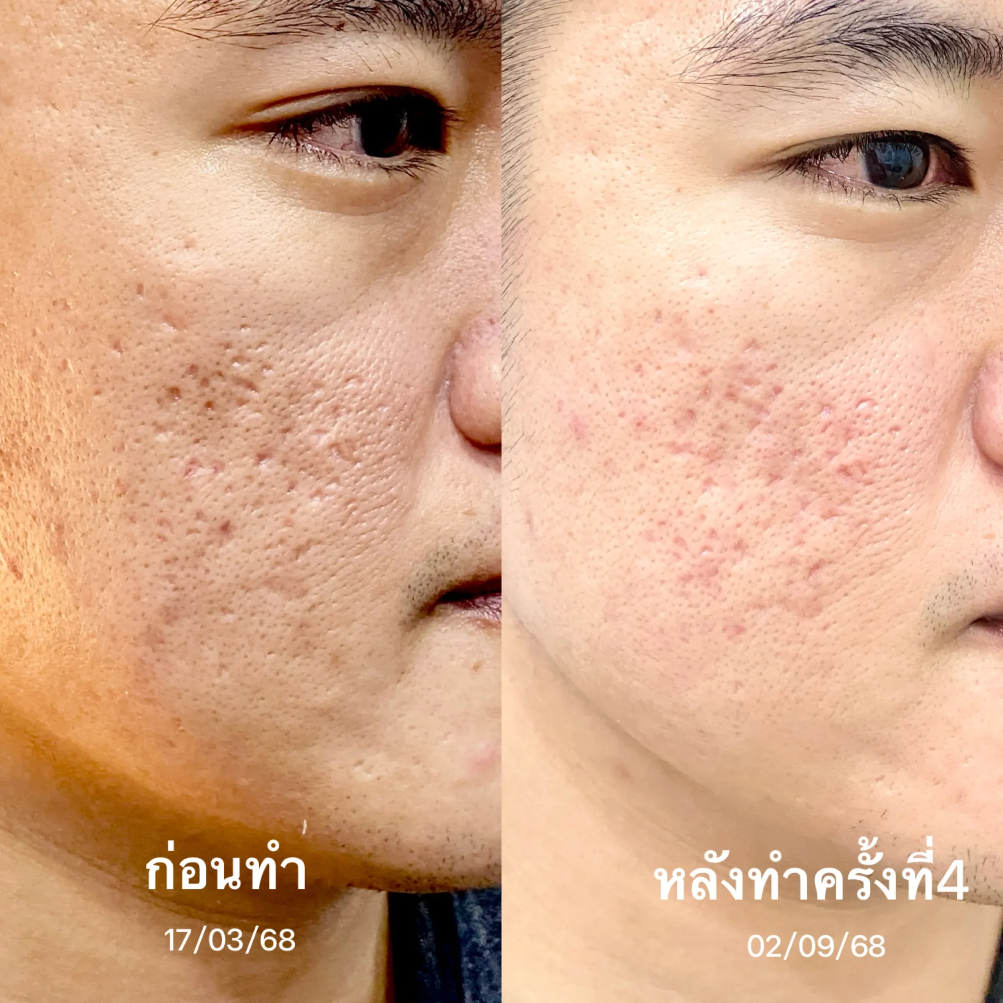 รีวิวรักษาหน้าหลุมสิว