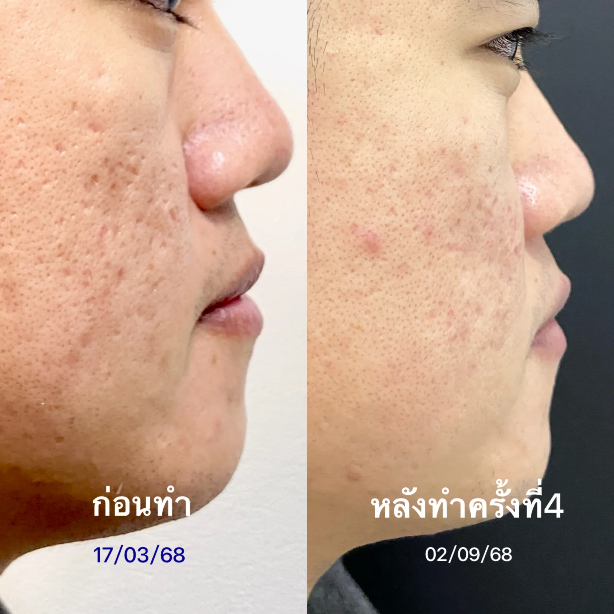 รีวิวรักษาหน้าหลุมสิว