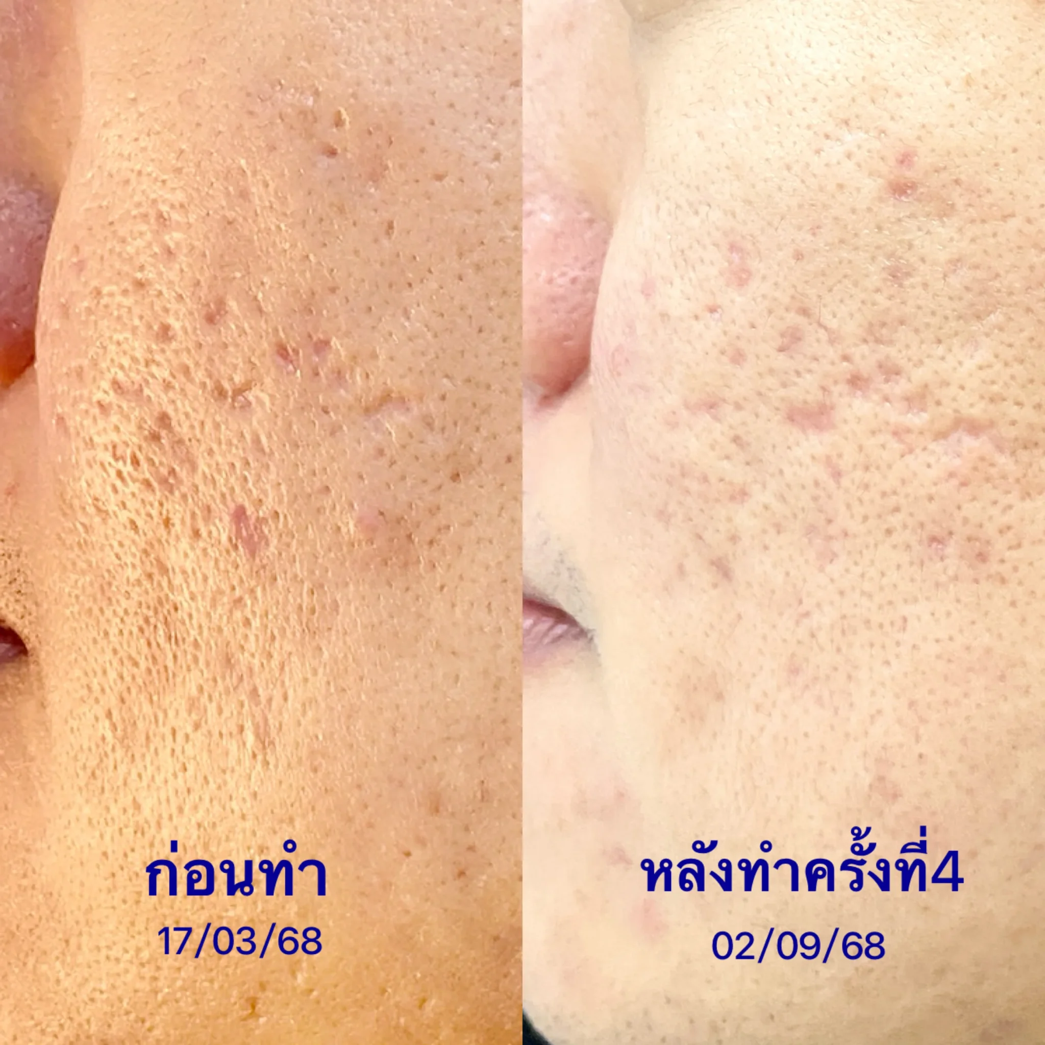 รีวิวรักษาหน้าหลุมสิว