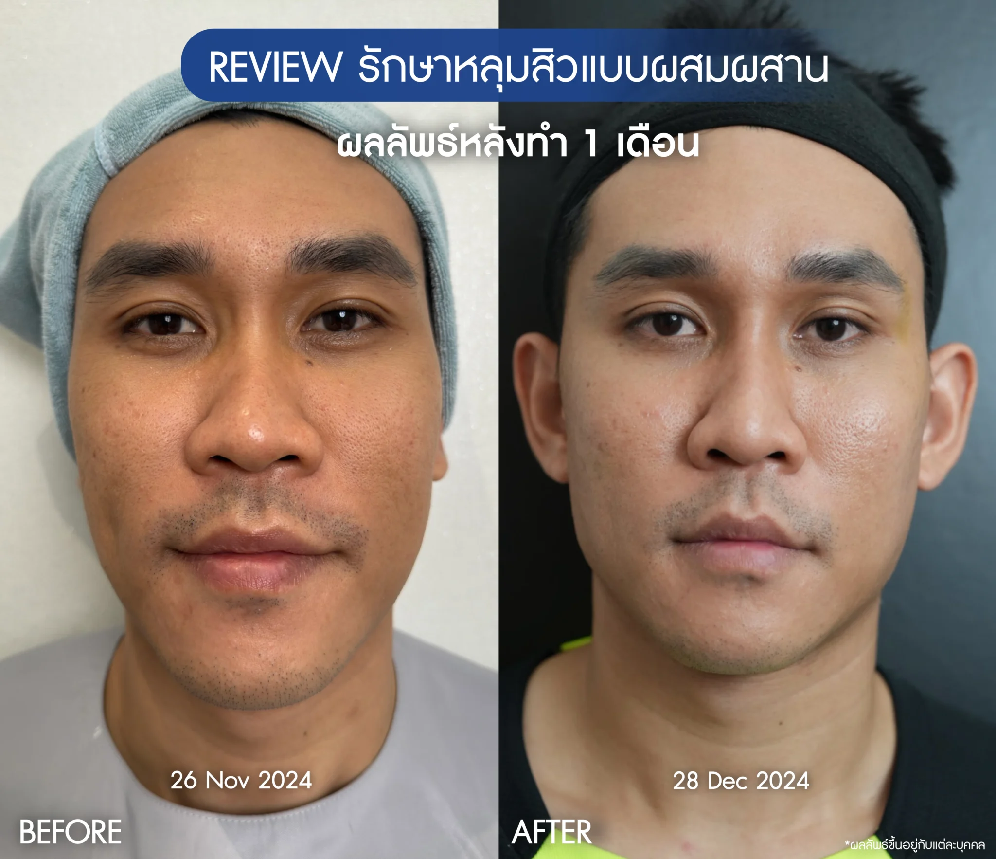 รีวิวรักษาหน้าหลุมสิว