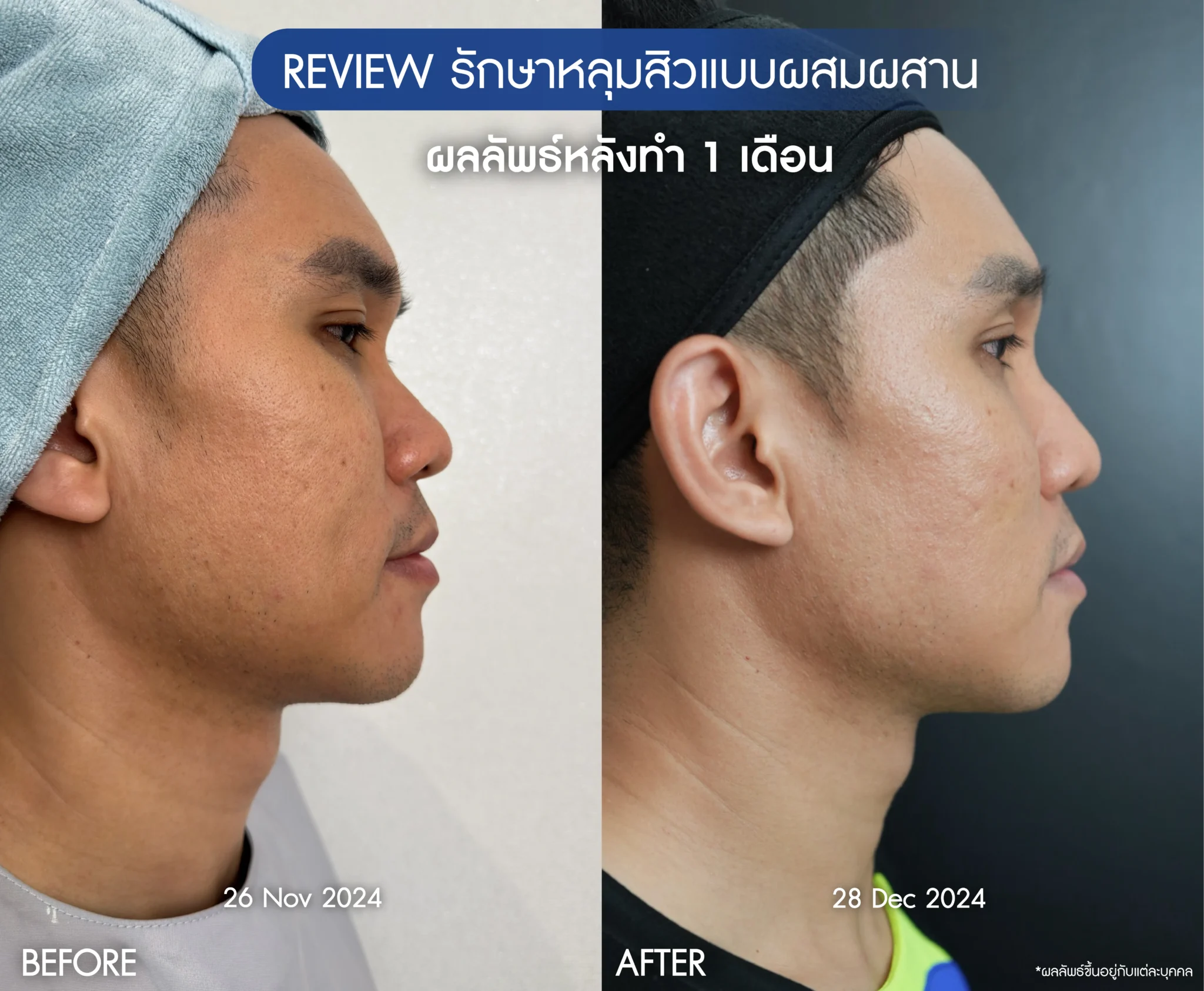 รีวิวรักษาหน้าหลุมสิว