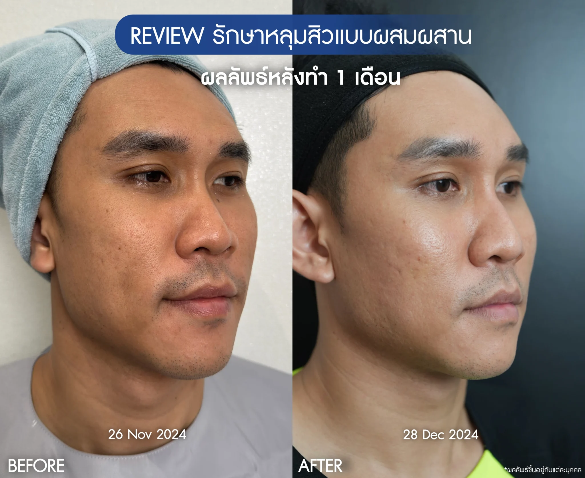 รีวิวรักษาหน้าหลุมสิว