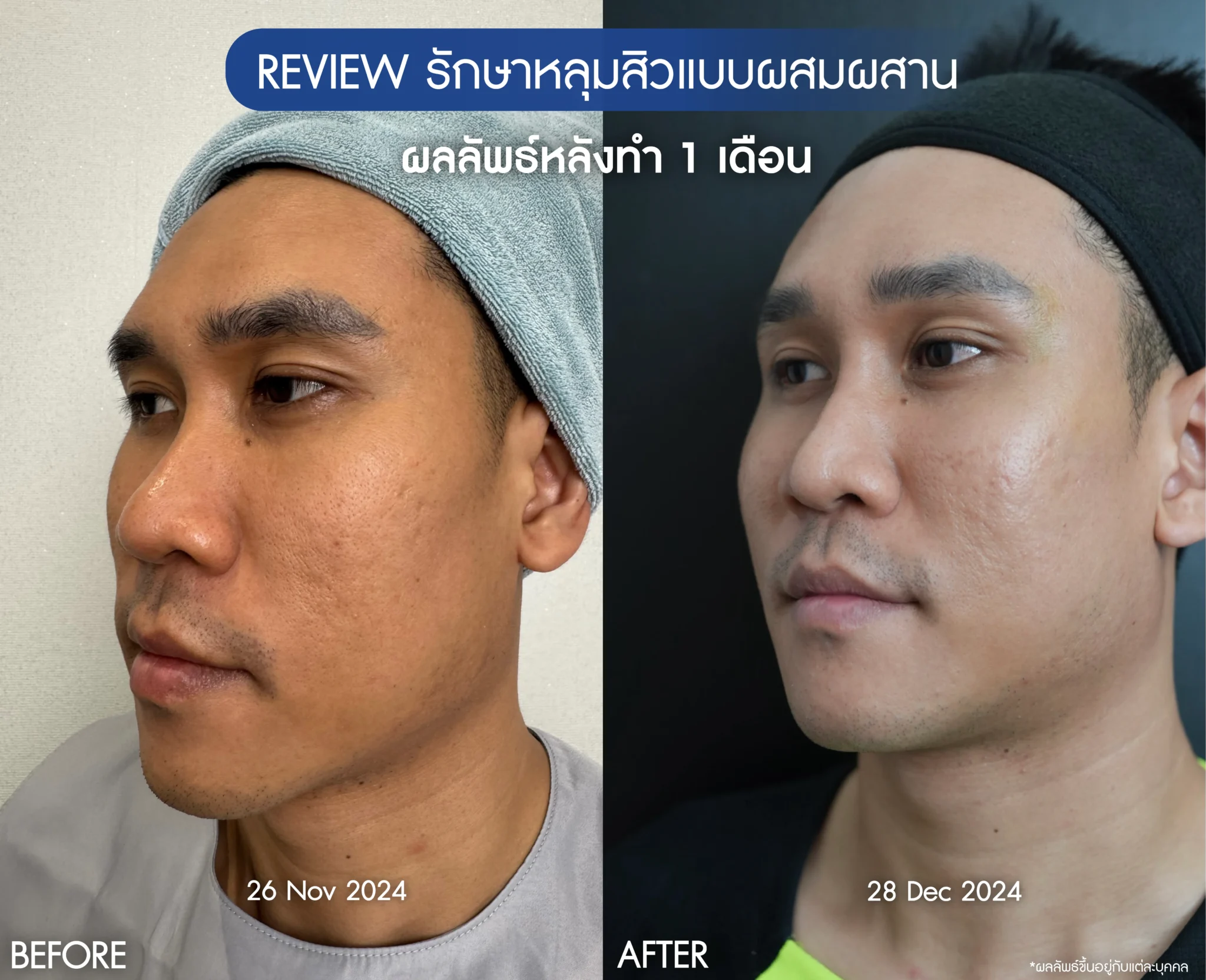 รีวิวรักษาหน้าหลุมสิว