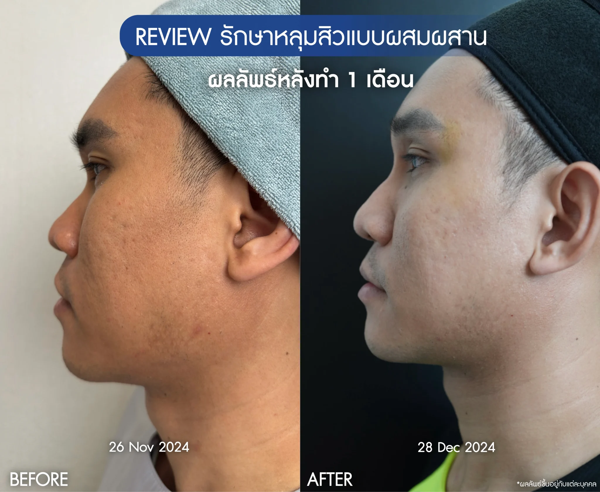 รีวิวรักษาหน้าหลุมสิว