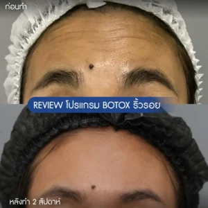 รีวิวโบท็อกซ์ริ้วรอย