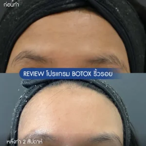 รีวิวโบท็อกซ์ริ้วรอย