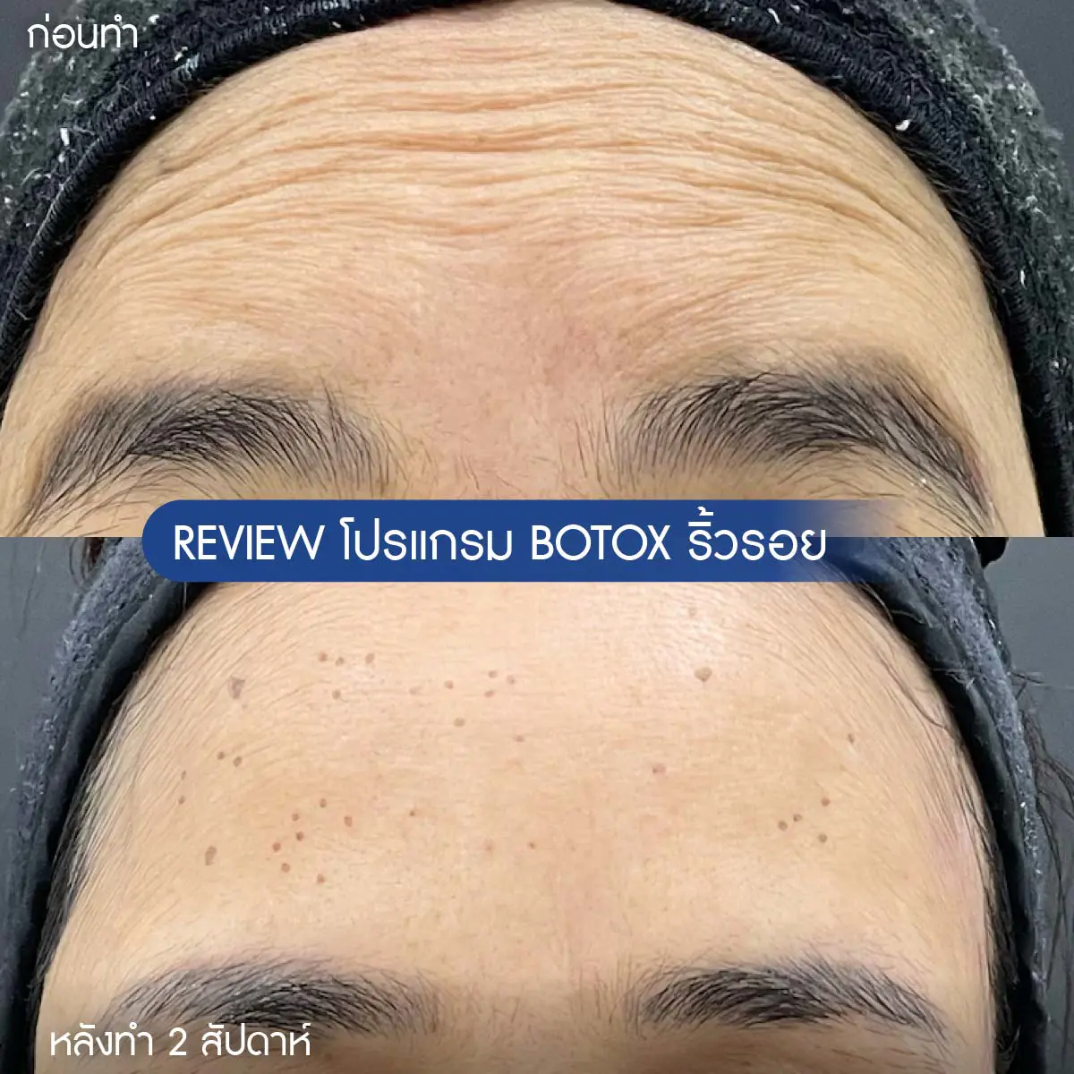 ฉีดโบท็อกซ์ ระยอง