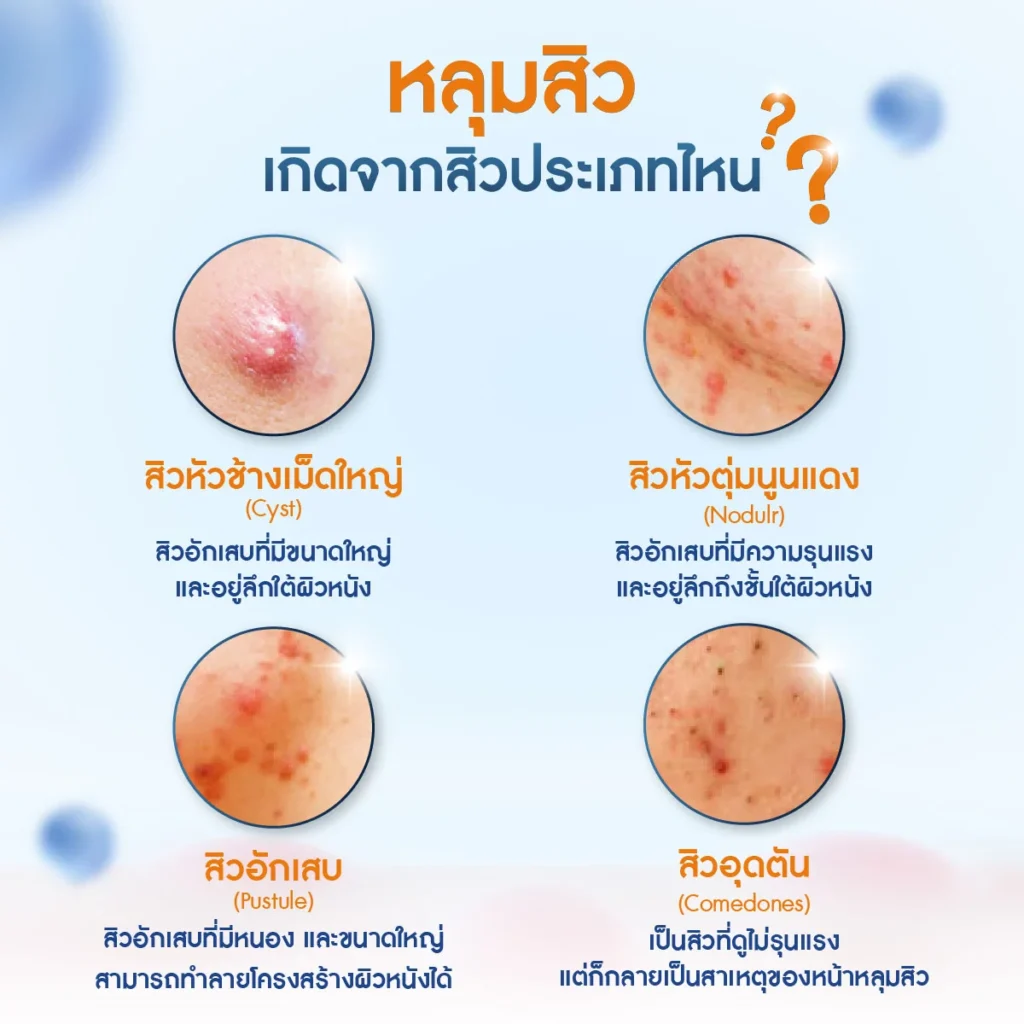 หน้าหลุมสิว