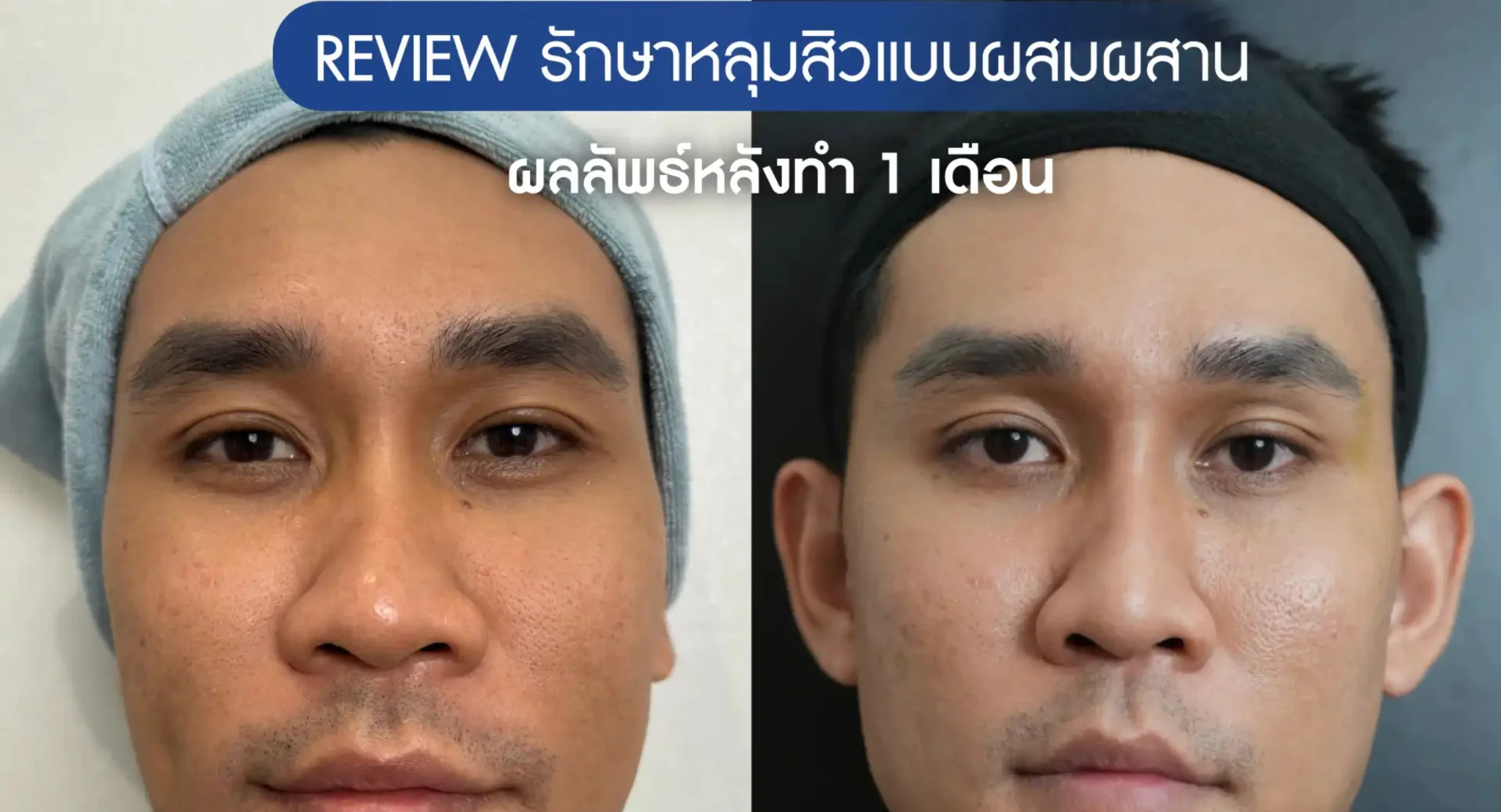 รูขุมขนกว้างแก้ยังไง (1,000)