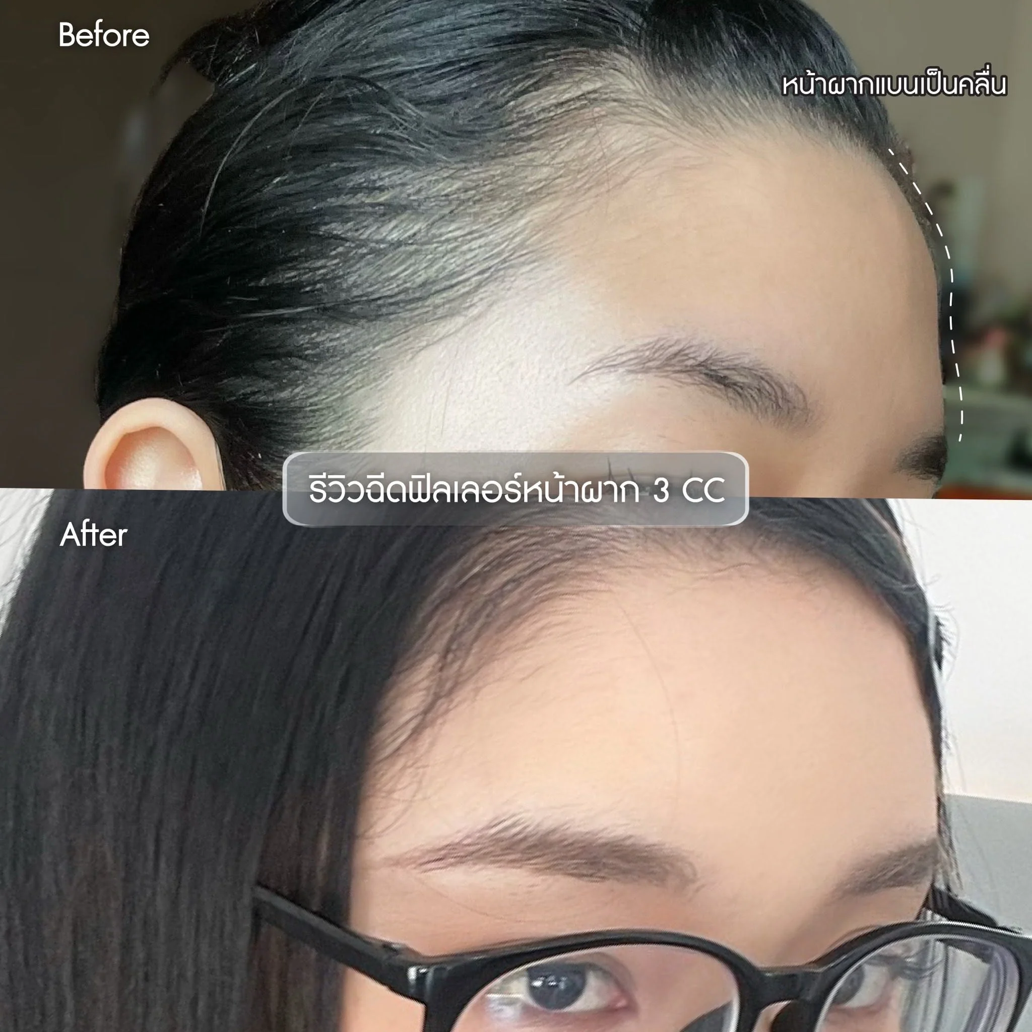 รีวิวโปรแกรมฉีดฟิลเลอร์หน้าผาก Hana Clinic 1