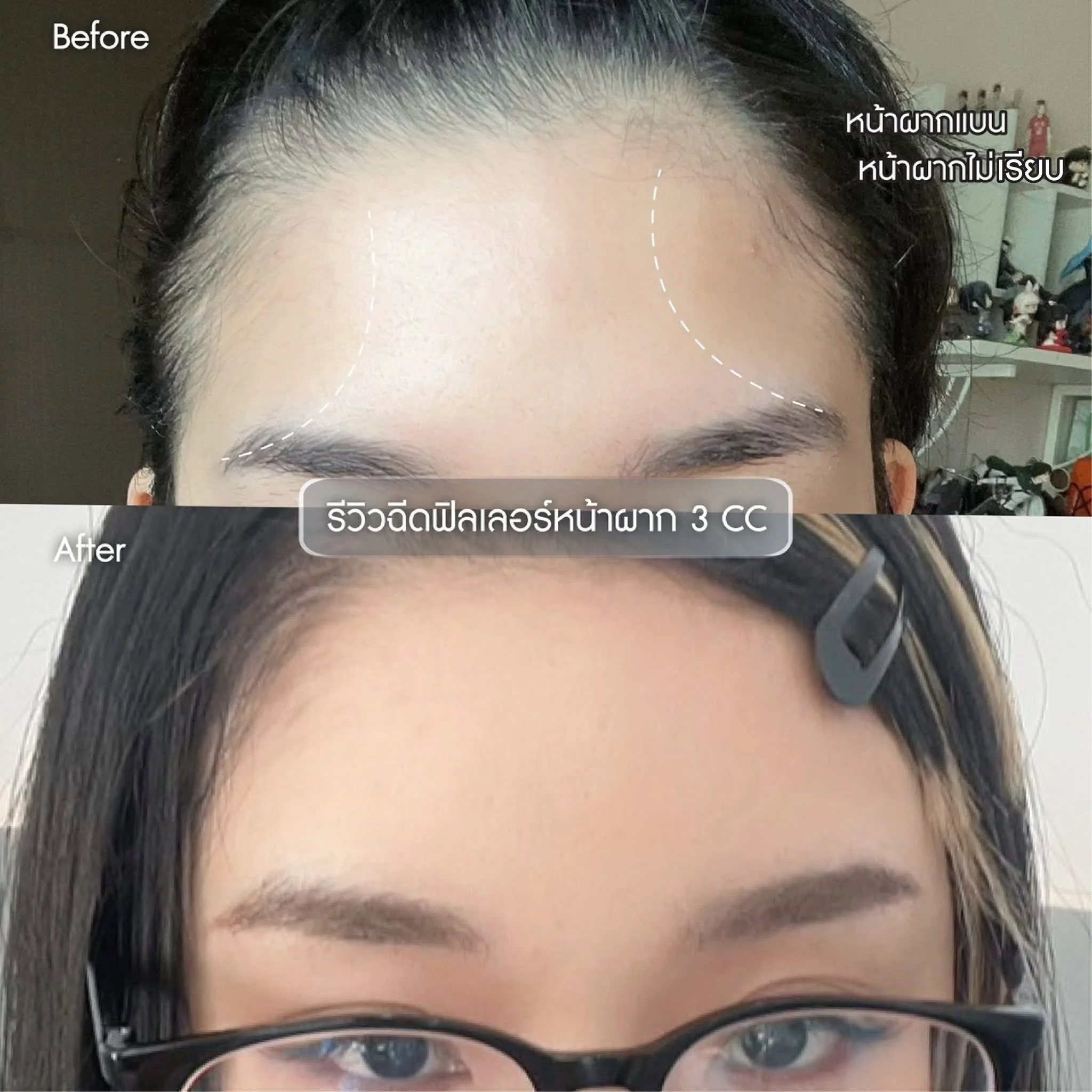 รีวิวโปรแกรมฉีดฟิลเลอร์หน้าผาก Hana Clinic