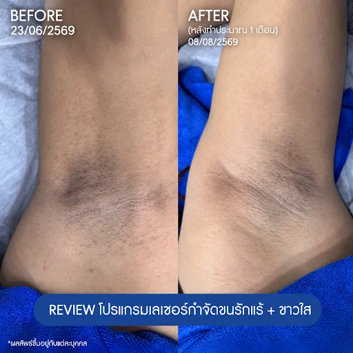 รีวิวโปรแกรมเลเซอร์ขนรักแร้ 1