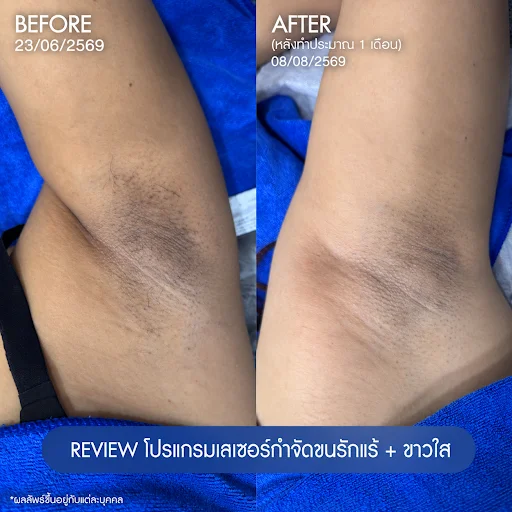รีวิวโปรแกรมเลเซอร์ขนรักแร้ 2