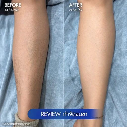 รีวิวโปรแกรมเลเซอร์ขนรักแร้ 3