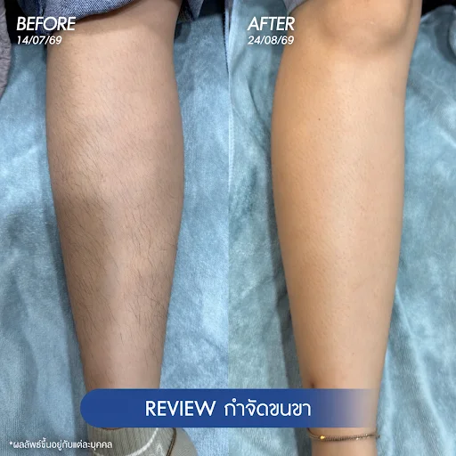 รีวิวโปรแกรมเลเซอร์ขนรักแร้ 4