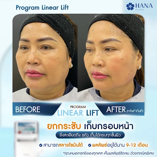 เคสรีวิวยกกระชับ hifu hana clinic 1