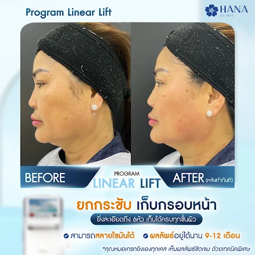 เคสรีวิวยกกระชับ hifu hana clinic 2