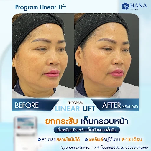 เคสรีวิวยกกระชับ hifu hana clinic 3