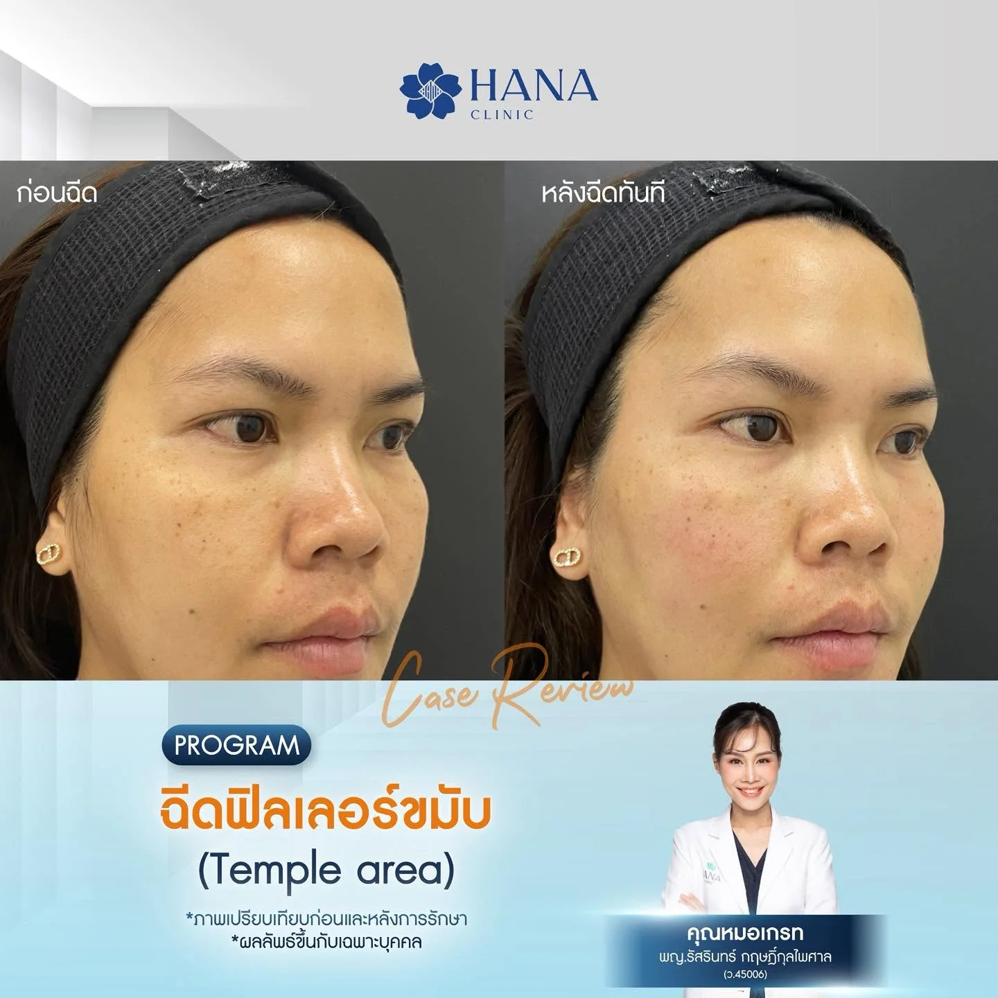 โปรแกรมฟิลเลอร์ขมับ ระยอง1