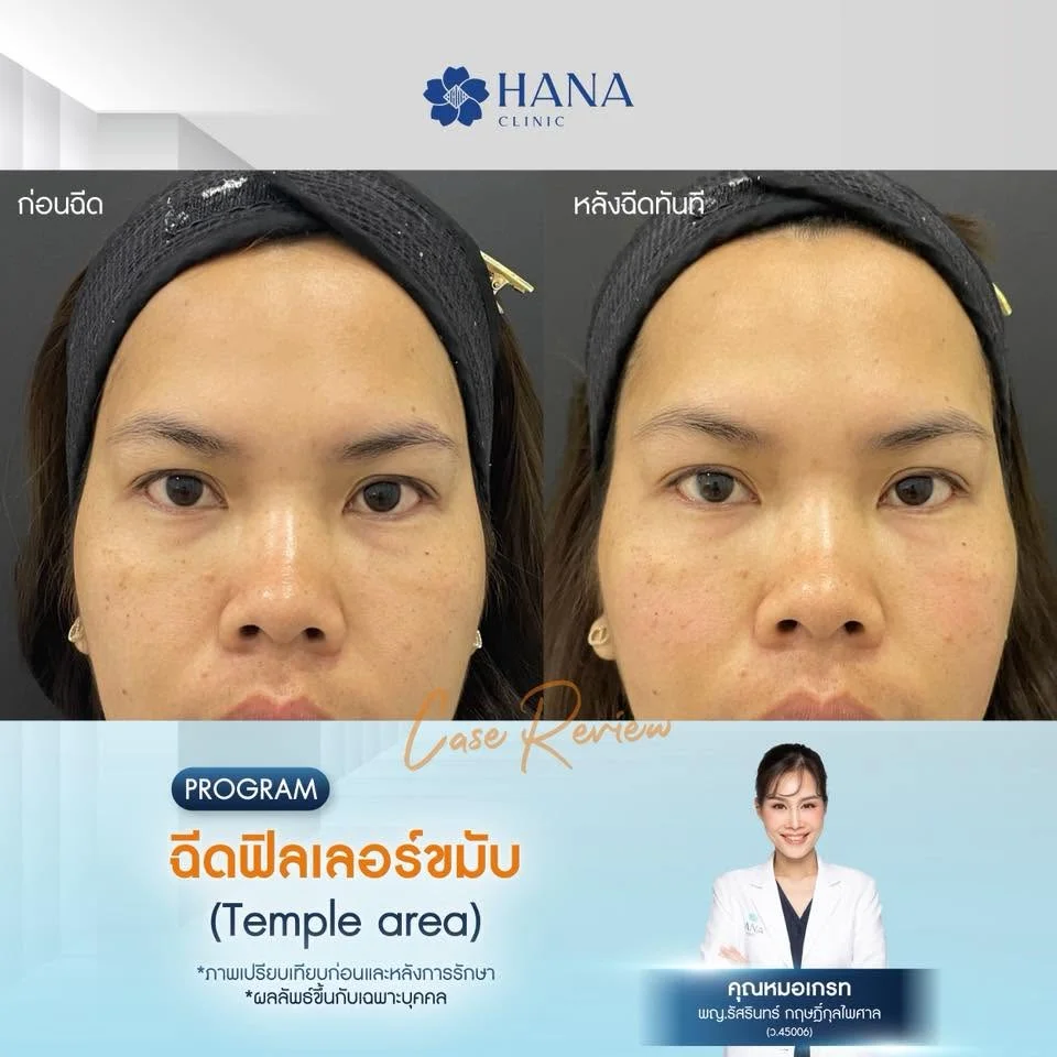 โปรแกรมฟิลเลอร์ขมับ ระยอง2