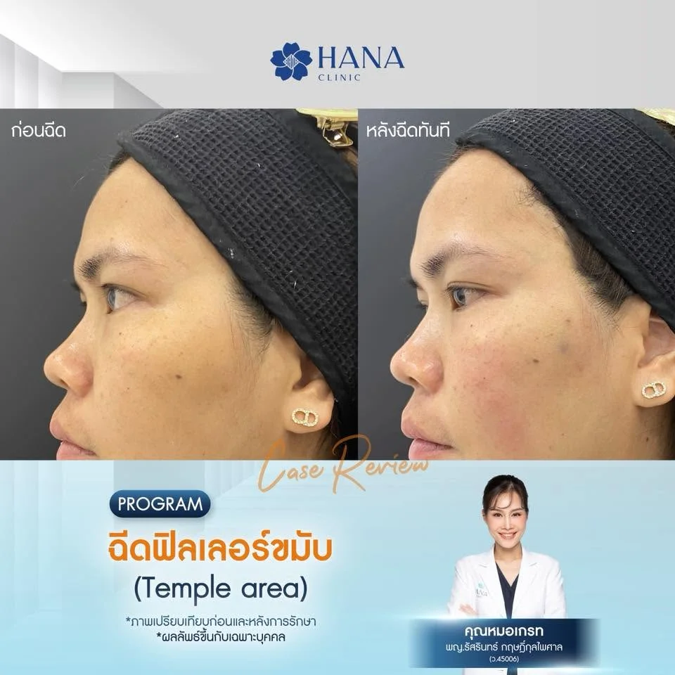 โปรแกรมฟิลเลอร์ขมับ ระยอง3